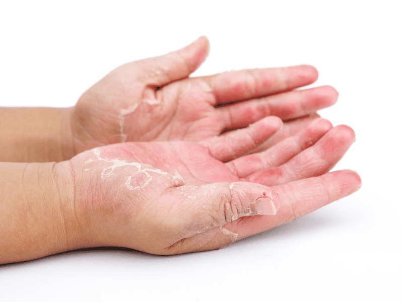 huidschimmel kan op verschillende manieren voorkomen